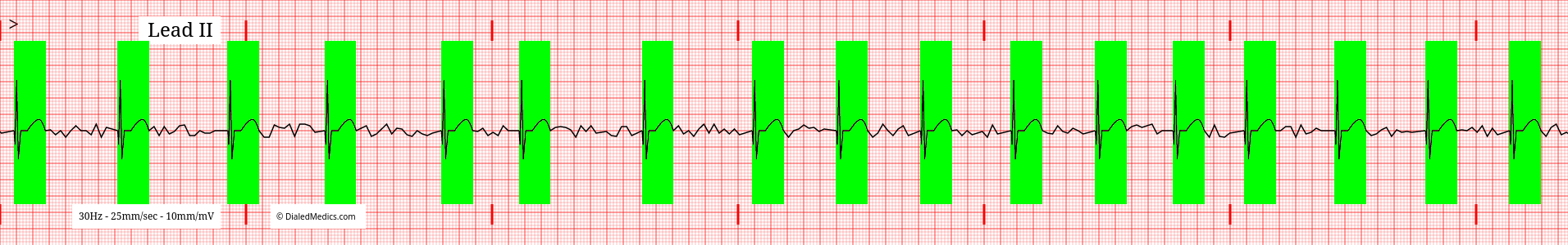 The Atrial Fibrillation Afib Ekg Ecg