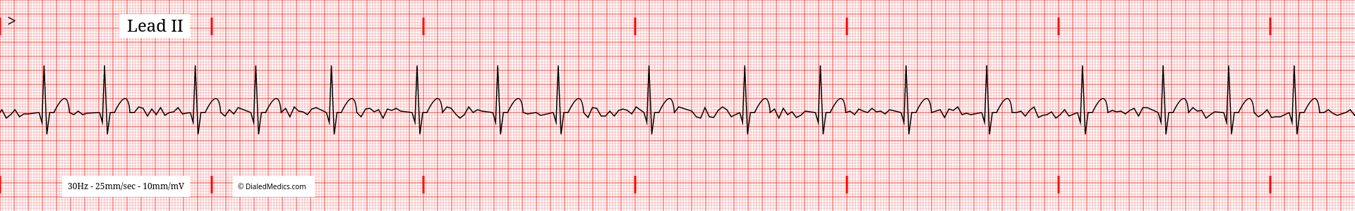 EKG tracing printout of Atrial Fibrillation.