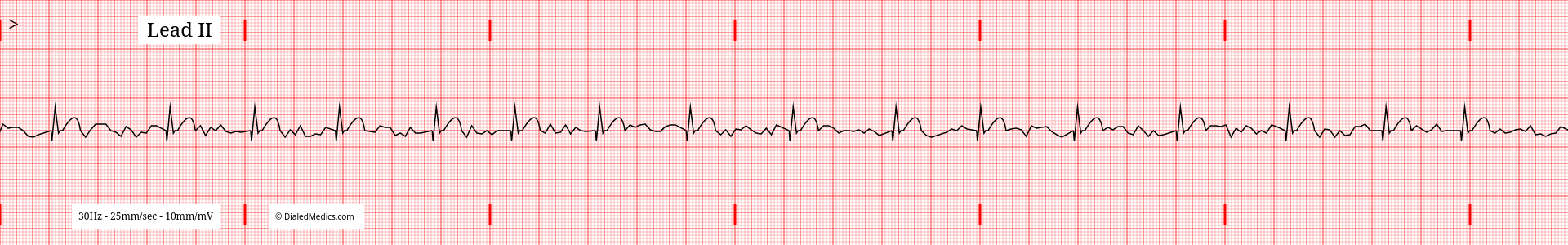 ECG tracing of Atrial Fibrillation (aFib.)