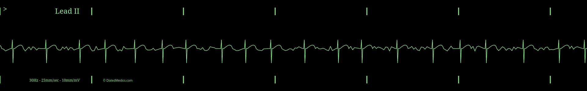 EKG monitor capture of aFib.