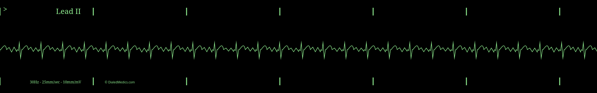 Cardiac monitor capture of Atrial Flutter (aFlutter.)