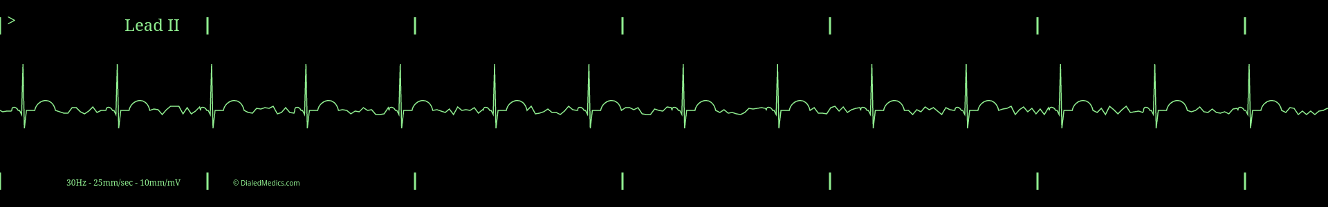 Sinus Bradycardia monitor capture with moderate artifact on the baseline.