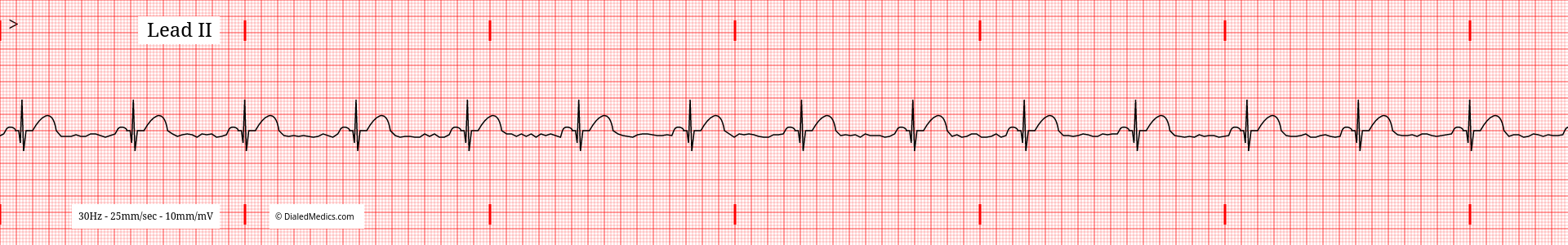 Example of a wandering baseline on an EKG tracing of Sinus Bradycardia.