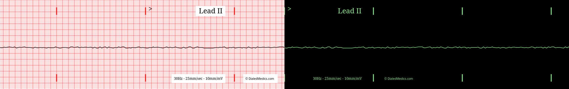EKG graph paper and cardiac monitor screen display examples.