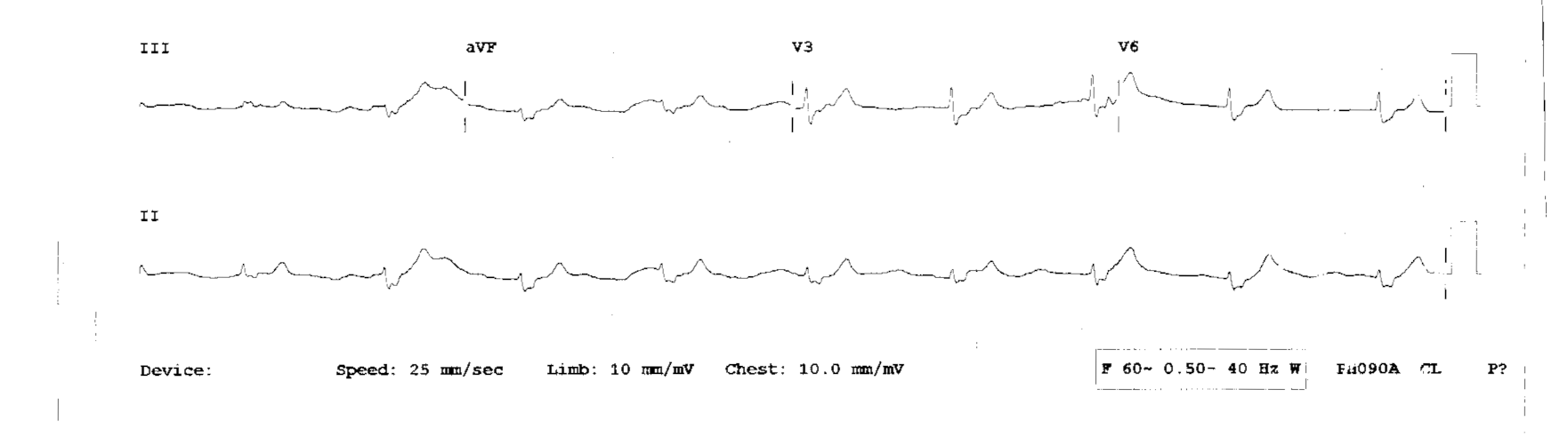 Example of low quality EKG photocopy.