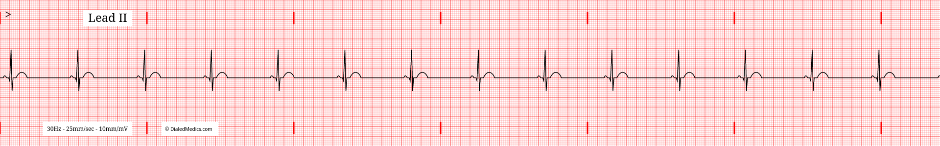 Example ECG without baseline artifact.