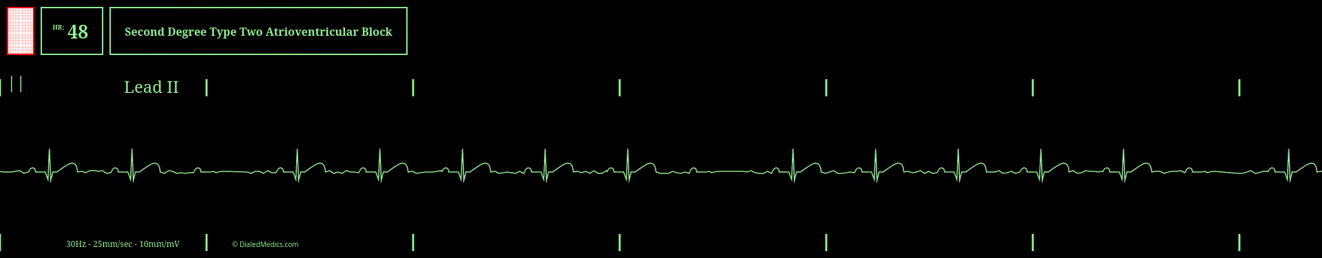 Gif animation of a cardiac monitor showing an intermittent Second Degree Type Two Heart Block.