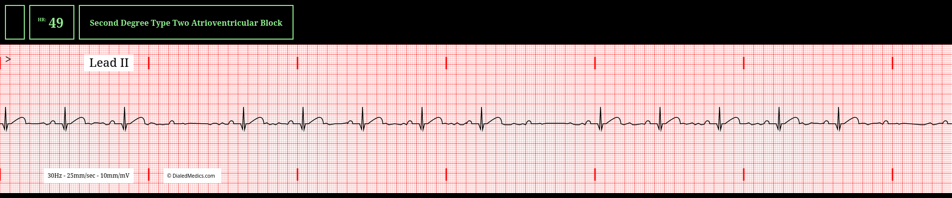 19sec electrocardiogram tracing of an apparent Second Degree Type Two 5:1 Heart Block