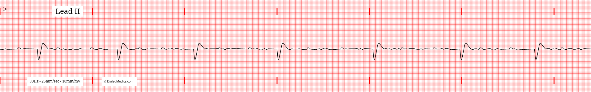 ECG tracing of a Third Degree Atrioventricular Heart Block.