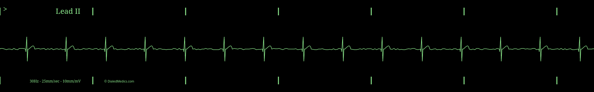 EKG monitor capture of a Junctional Rhythm.