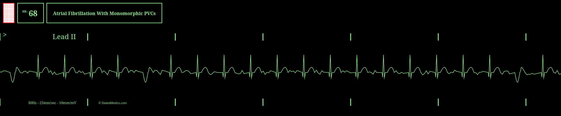 Unifocal ectopy (monomorphic PVC's) example EKG monitor capture.