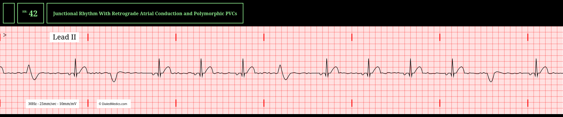 An example of polymorphic ectopy (multifocal PVC's) in a Junctional Rhythm.