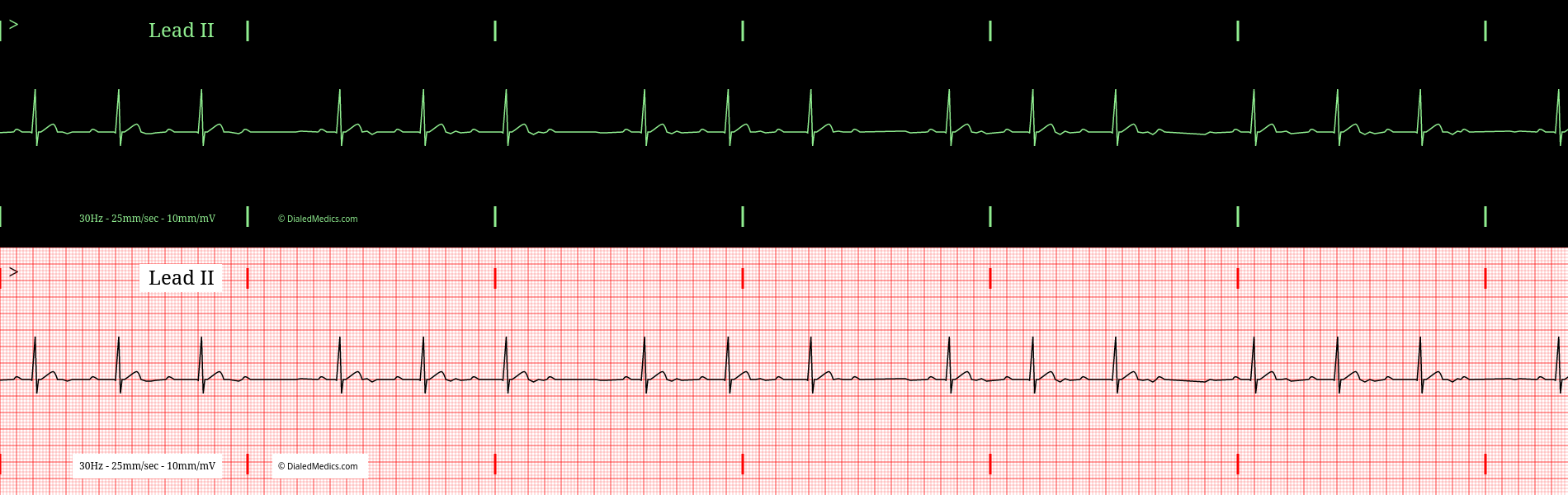 EKG Monitor capture and tracing printout of a Heart Block.