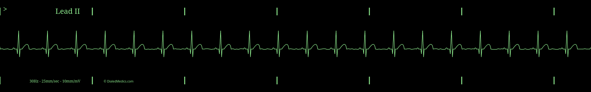 Regular Sinus Rhythm monitor capture.