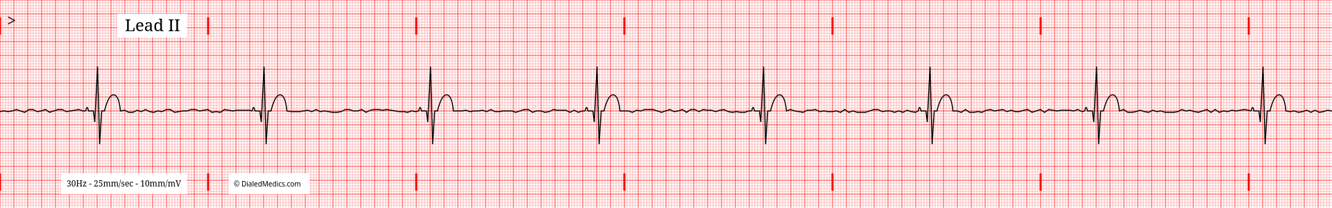 Electrocardiogram tracing of Sinus Bradycardia.