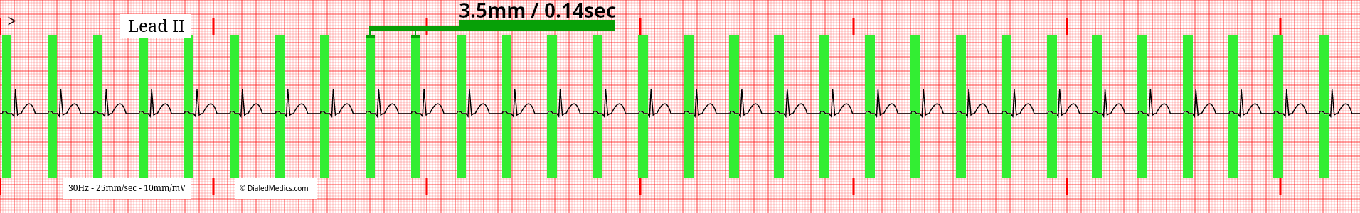 ECG tracing of a normal sinus rhythm with a HR of 94 and P-R Intervals marked.