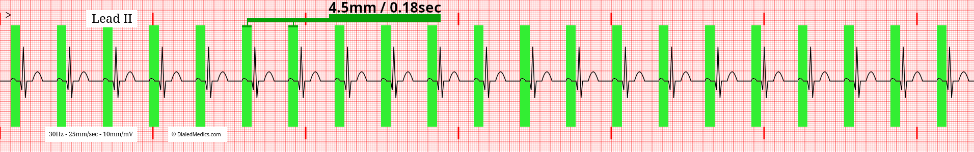 ECG tracing of a Normal Sinus Rhythm with a HR of 66 and P-R Intervals marked.