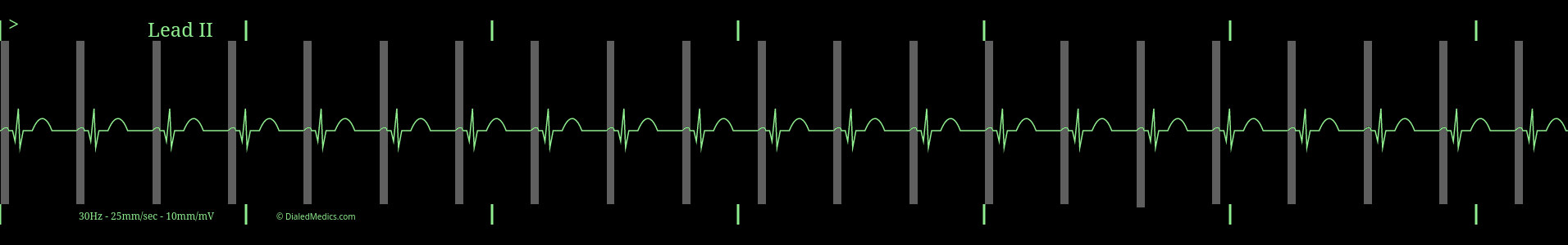 ECG monitor screen capture of Regular Sinus Rhythm with highlighted P waves and a HR of 65.