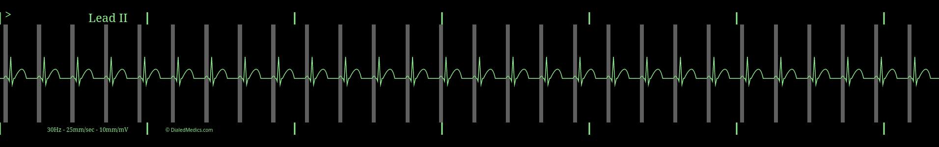 EKG monitor screen capture of Regular Sinus Rhythm with highlighted P waves and a HR of 65.