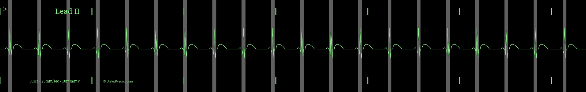 ECG monitor screen capture of Regular Sinus Rhythm with highlighted QRS Complexes and a HR of 63.