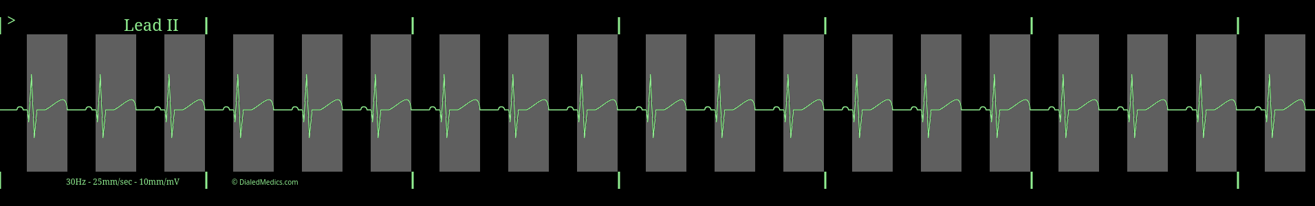 EKG tracing of regular sinus rhythm with highlighted Q-T Intervals.