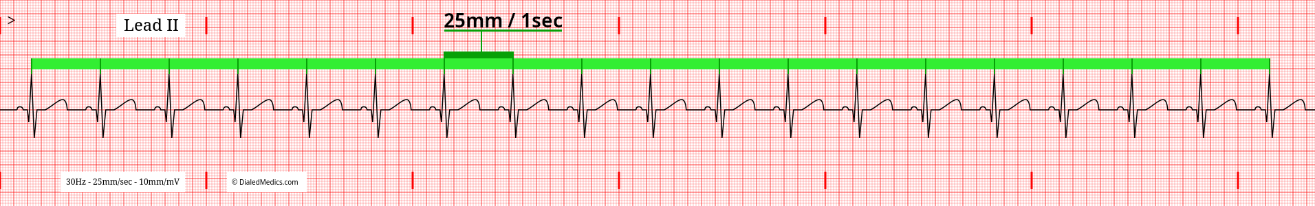 Software generated EKG tracing of a normal sinus rhythm at 60bpm with R-R Interval of 25mm / 1sec marked .