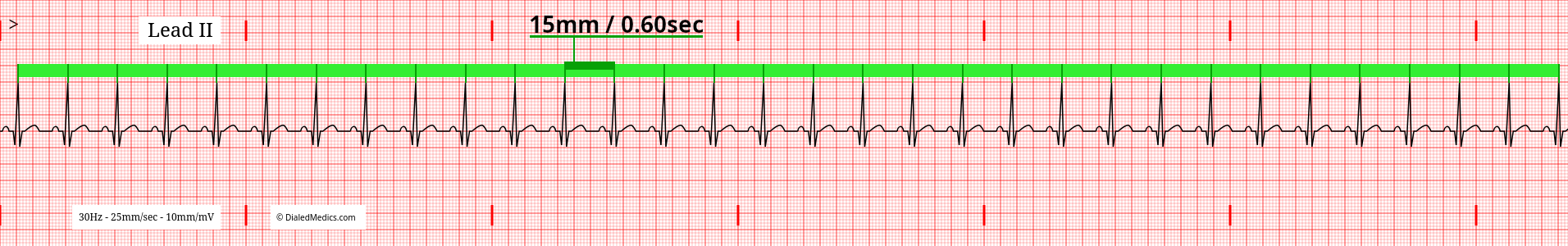 Software generated EKG tracing of a Normal Sinus Rhythm at 99bpm with R-R Interval of 15mm / 0.60sec marked.
