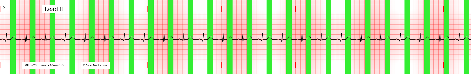 ECG tracing of a normal sinus rhythm with T Waves marked.