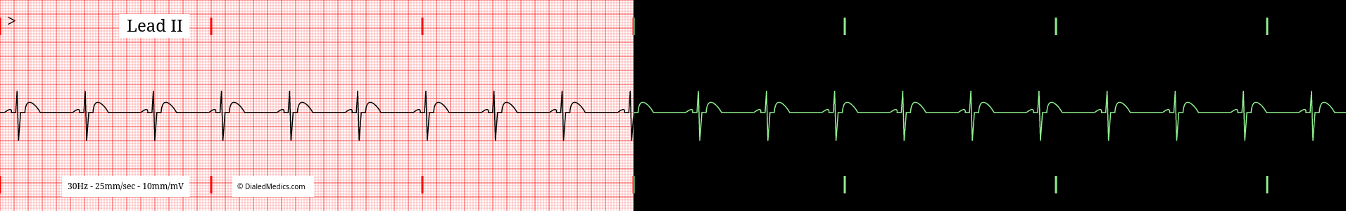 Normal Sinus Rhythm EKG example, split printout / monitor display.