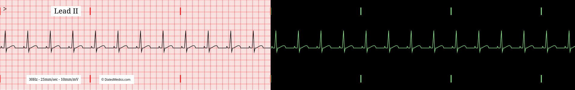 NSR / RSR example EKG / ECG, split printout / monitor display.