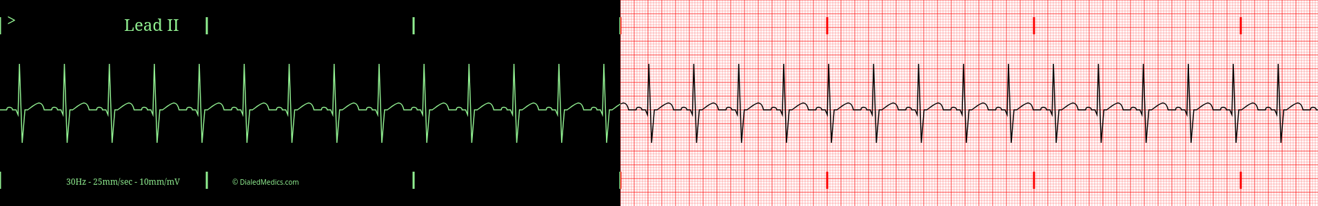 Regular Sinus Rhythm EKG example, split printout / monitor display.