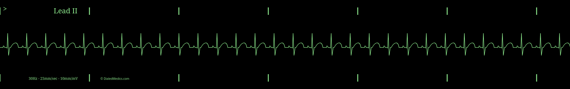 Software generated Normal Sinus Rhythm EKG monitor capture with HR of 94.