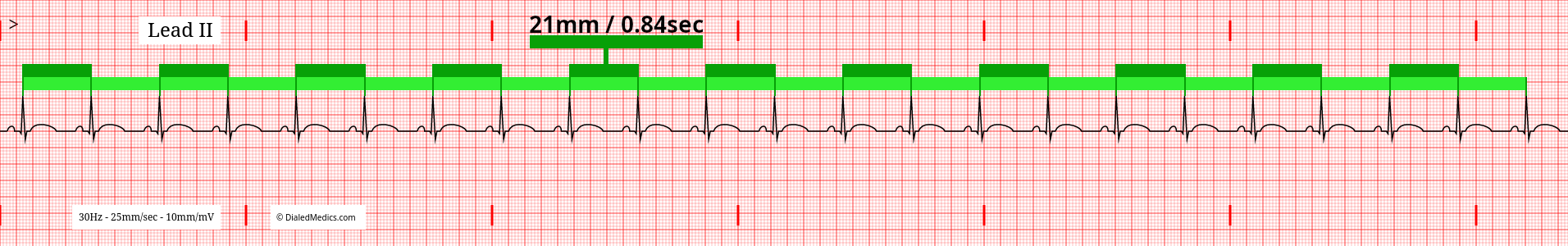 ECG tracing of a Normal Sinus Rhythm with 21mm equal R-R Intervals highlighted.