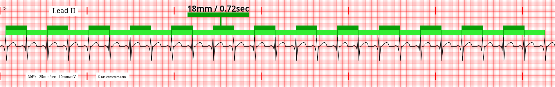 Software generated EKG tracing of a Normal Sinus Rhythm at 84bpm with R-R Interval of 18mm / 0.72sec marked.
