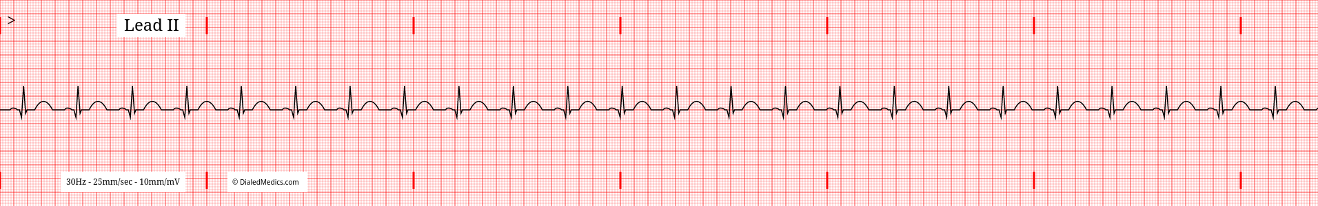 Software generated Normal Sinus Rhythm EKG tracing with a HR of 76.