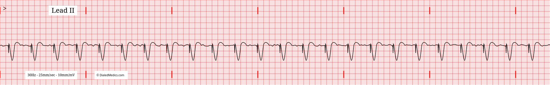 EKG tracing showing a ventricular pacemaker.