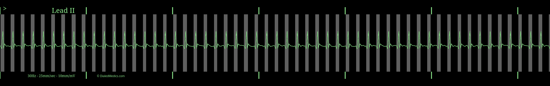 EKG Monitor capture of SVT with QRS highlighted in grey.