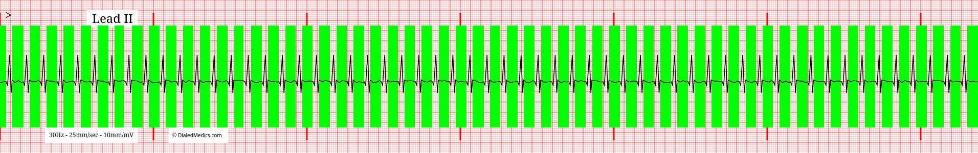 SVT tracing with green highlights over S-Q segments.