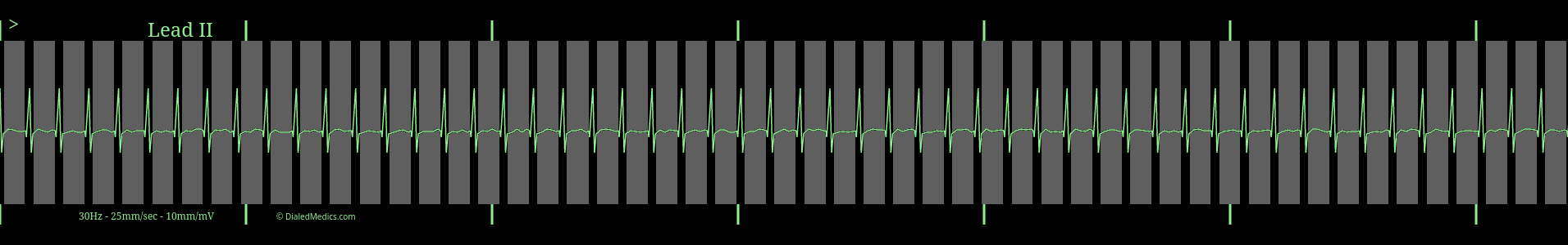 Supraventricular Tachycardia highlighting the absence of a clear origin.