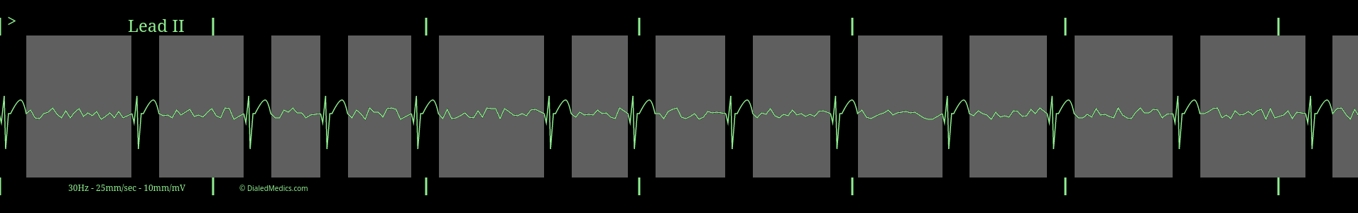 AFib monitor capture with fibrillation waves highlighted in grey.