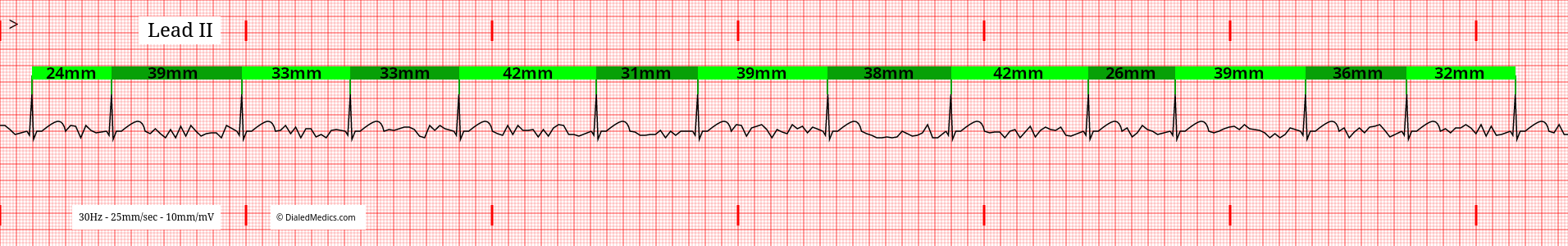 Atrial Fibrillation tracing with R-R Intervals marked.