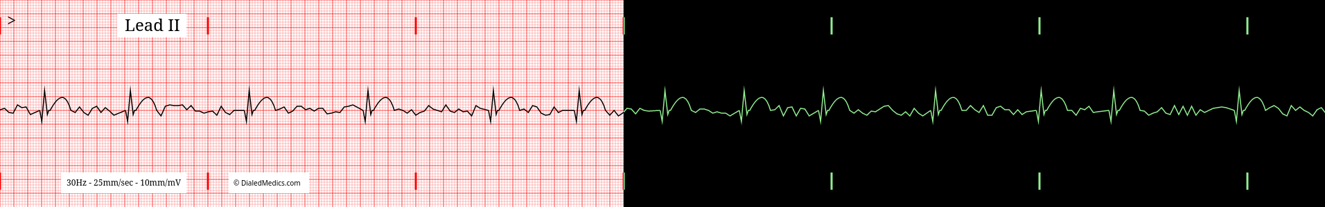 Atrial Fibrillation EKG practice tracing.