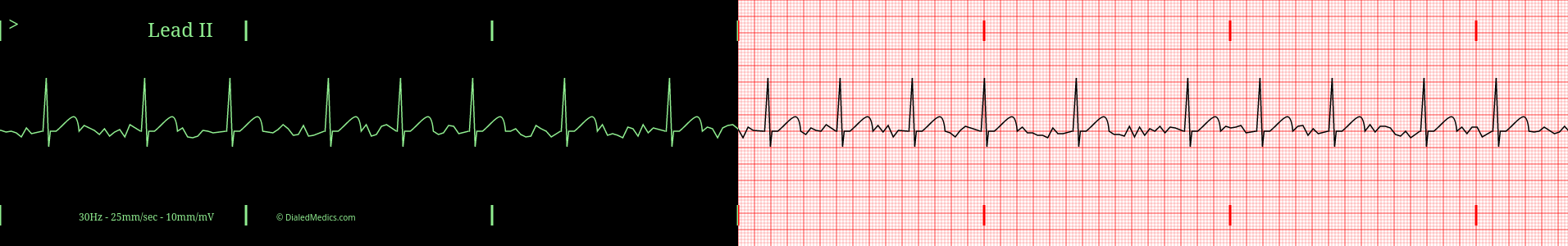 AFib ECG practice tracing.