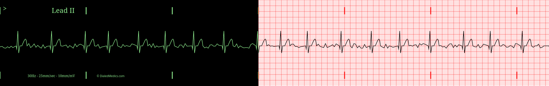 AFib practice ECG.