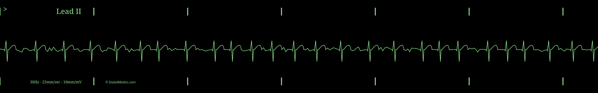 AFib with a Rapid Ventricular Response at a rate of 120.