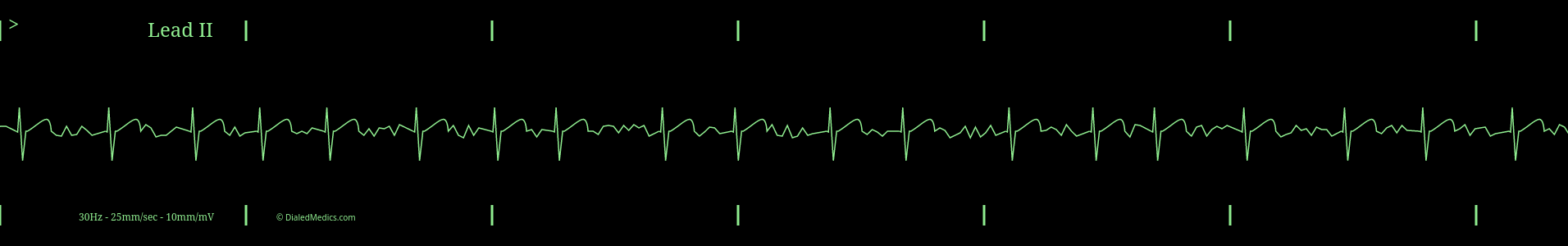 Software generated AFib EKG monitor capture with HR of 88.