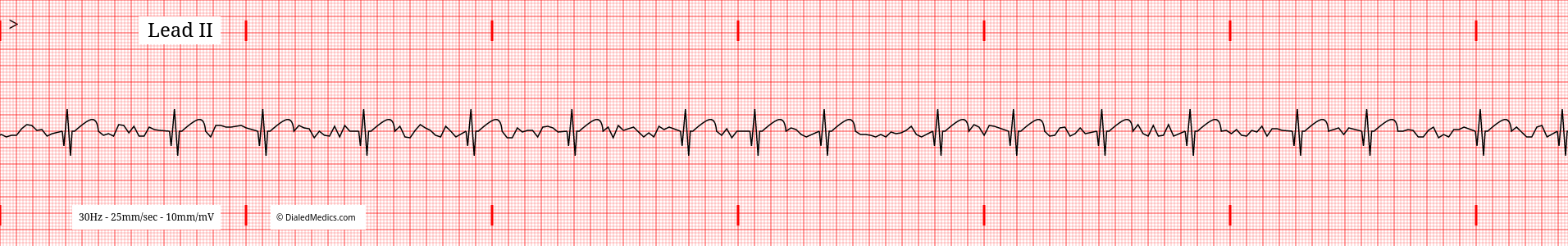 Software generated Atrial Fibrillation EKG tracing with a HR of 76.