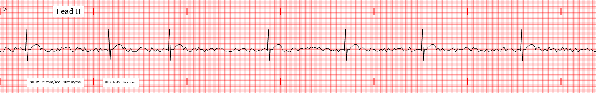 AFib with a Slow Ventricular Response EKG tracing.