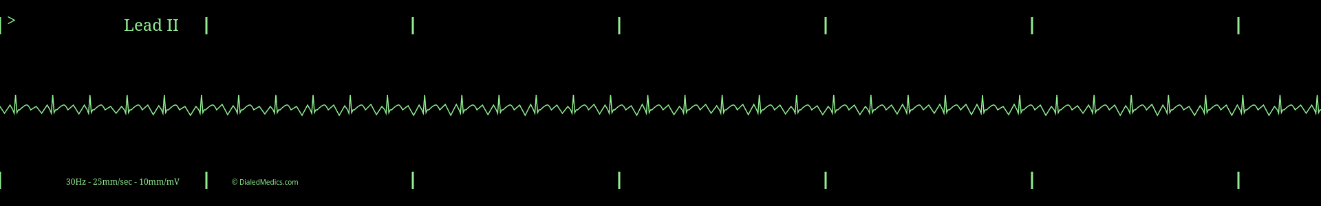 ECG monitor with Atrial Flutter with a Rapid Ventricular Response displayed.