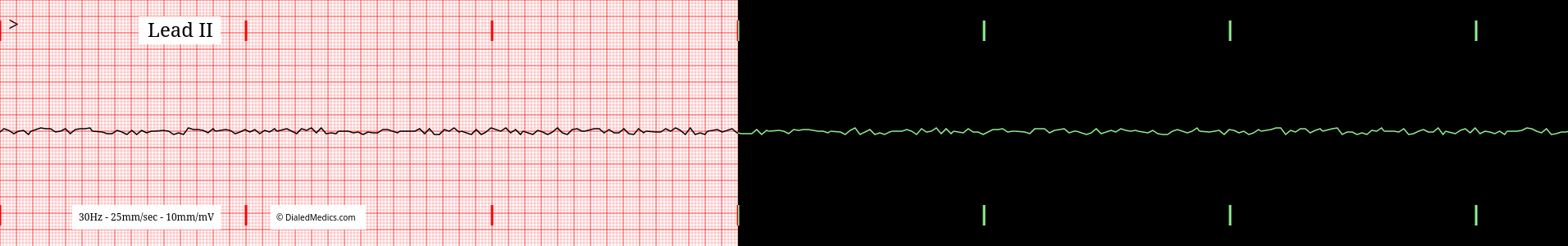 Practice Asystole EKG.